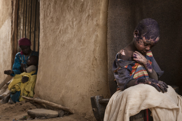 Contemporary Issues, 2nd prize singles
Adriane Ohanesian, USA, 2015, The Forgotten Mountains of Sudan. Adam Abdel, 7, was severely burned after a bomb was dropped by a Sudanese government Antonov plane next to his family home in Burgu, Central Darfur,
Sudan. 27 February 2015.