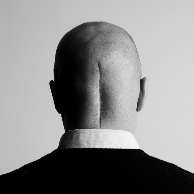 Head On Portrait Prize - 1st Place - Antonio Heredia. &ldquo;Some years ago, 29 year-old lawyer Oscar Prieto was diagnosed with brain cancer. Following surgery, chemotherapy and radiotherapy, Oscar was able to beat the disease. Nowadays, he is the president of ASATE, an organization which provides help and guidance to those affected by brain cancer. By showing his own scars, Oscar tries to inspire and demonstrate that one can overcome cancer.&rdquo;