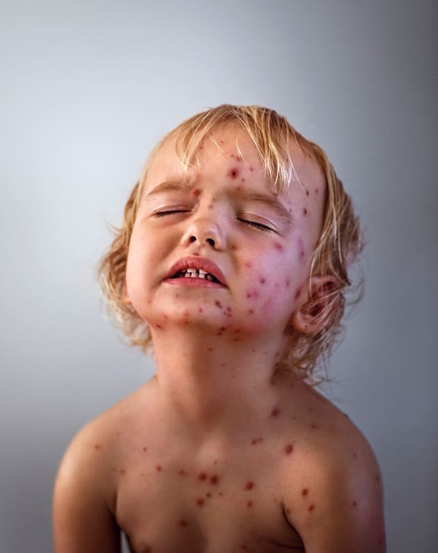 Chicken Pox by Troy Goodall