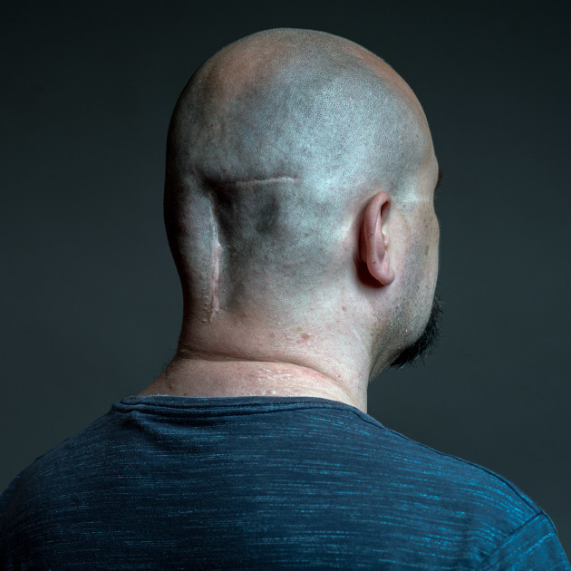Scarred, 2017 by Nicole Katherine Wells. Colin had a brain tumour back in 2015 &ndash; it was a benign meningioma. Doctors determined that the tumour was still growing, so they had to remove it. (The surgeon told Colin he would probably have only had a year to live before it killed him). After surgery Colin&rsquo;s scar became infected, resulting in sepsis; it was one of the scariest times of his life. Because Colin developed sepsis, they don't want to re-operate on his head to replace the missing plate with a new one. This is why he has a dip in the back of his head, which makes him feel slightly vulnerable.