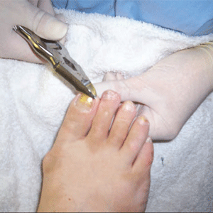 Looking after your toenails
